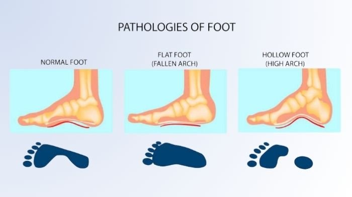 How to Stop Shoes from Gapping on the Sides